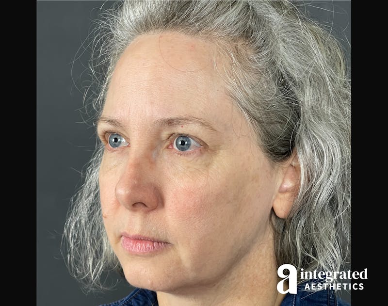 IPL Photofacial Before & After Gallery - Patient 148574508 - Image 10