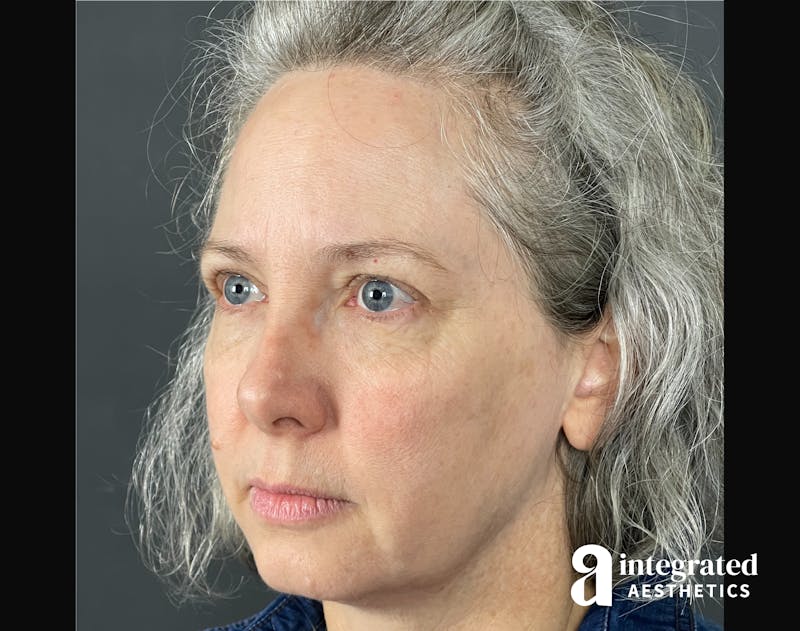 Wrinkle Relaxers Before & After Gallery - Patient 148574305 - Image 10