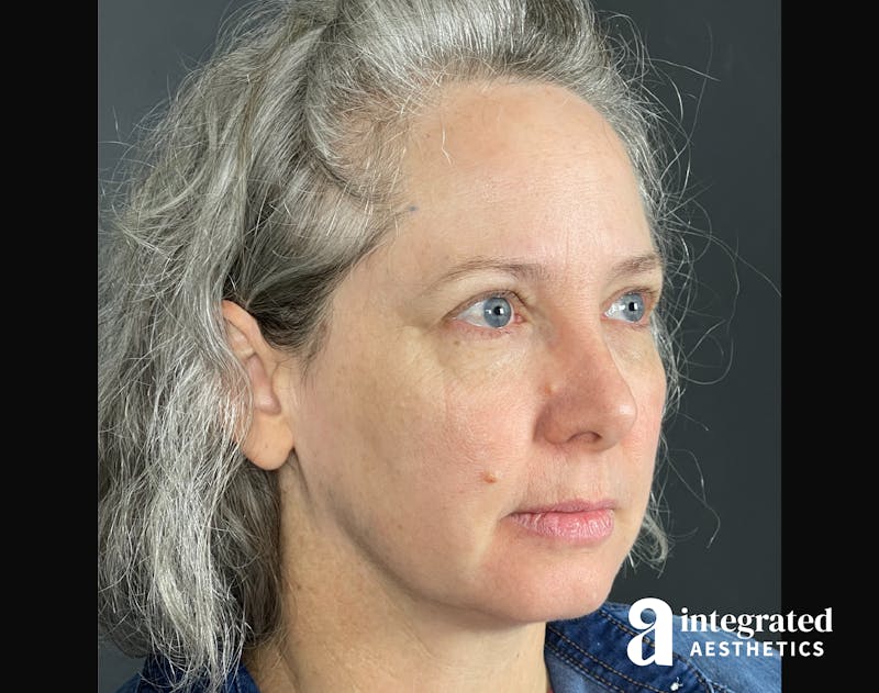 IPL Photofacial Before & After Gallery - Patient 148574508 - Image 14