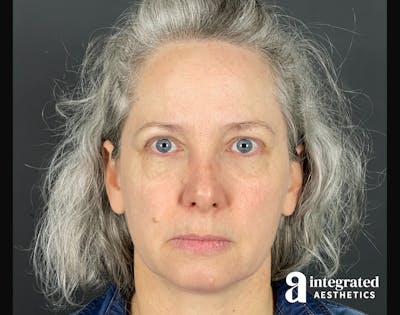 IPL Photofacial Before & After Gallery - Patient 148574508 - Image 2