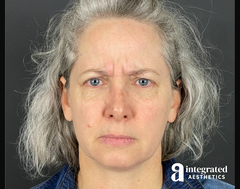 IPL Photofacial Before & After Gallery - Patient 148574508 - Image 4