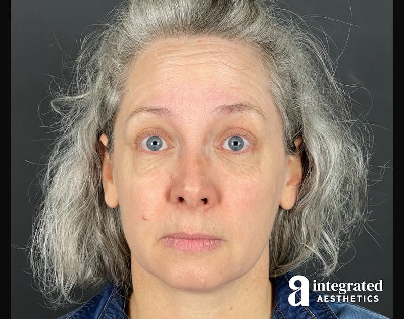 IPL Photofacial Before & After Gallery - Patient 148574508 - Image 6