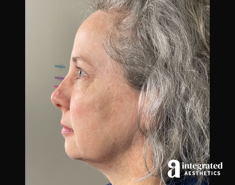 Wrinkle Relaxers Before & After Gallery - Patient 148574305 - Image 16