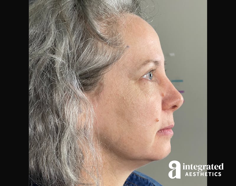 IPL Photofacial Before & After Gallery - Patient 148574508 - Image 18