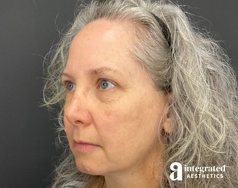 IPL Photofacial Before & After Gallery - Patient 148574508 - Image 9