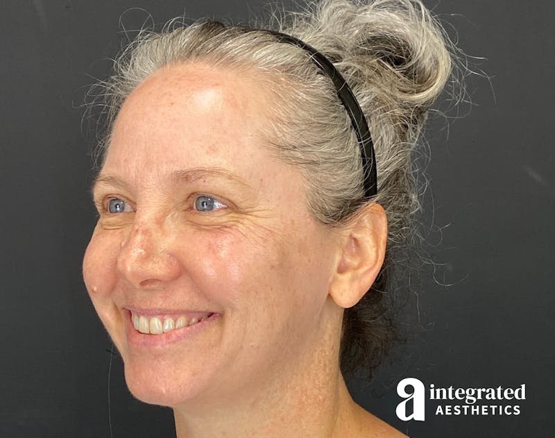 IPL Photofacial Before & After Gallery - Patient 148574508 - Image 11