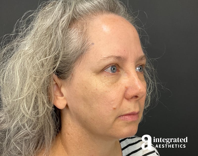 Wrinkle Relaxers Before & After Gallery - Patient 148574305 - Image 13