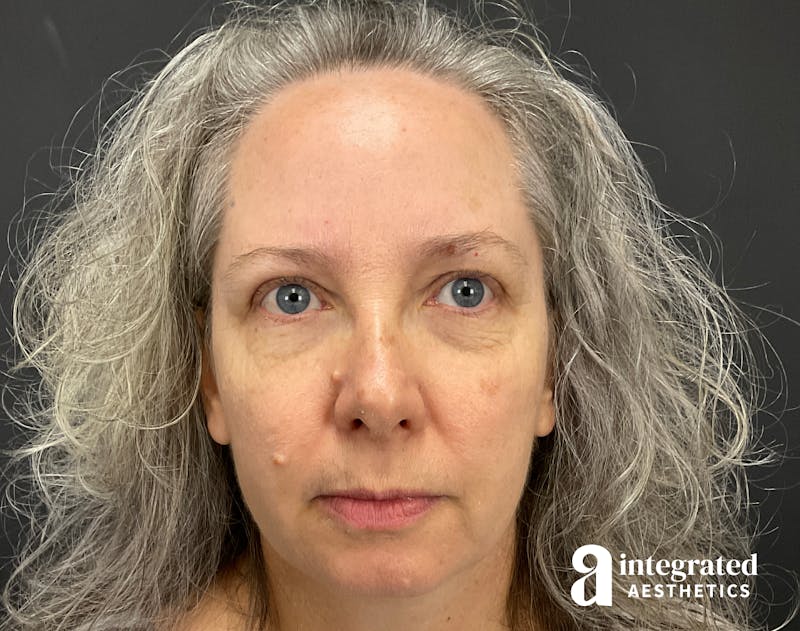 IPL Photofacial Before & After Gallery - Patient 148574508 - Image 1