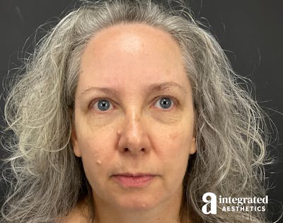 IPL Photofacial Before & After Gallery - Patient 148574508 - Image 1