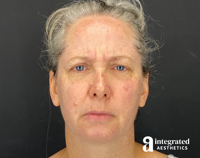 IPL Photofacial Before & After Gallery - Patient 148574508 - Image 3