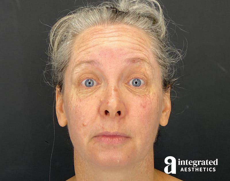 Wrinkle Relaxers Before & After Gallery - Patient 148574305 - Image 5