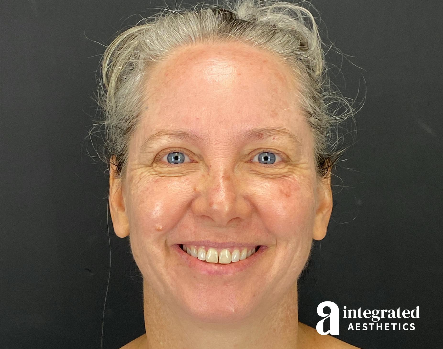 Before & after IPL photofacial treatment at Integrated Aesthetics