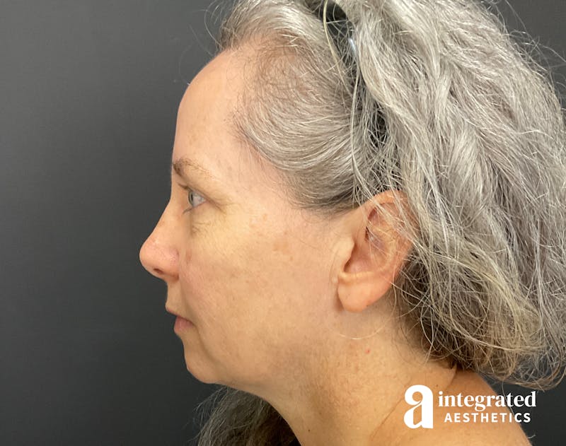 IPL Photofacial Before & After Gallery - Patient 148574508 - Image 15