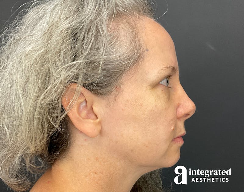 IPL Photofacial Before & After Gallery - Patient 148574508 - Image 17
