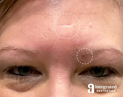 Cysts/Lipomas Before & After Gallery - Patient 157150409 - Image 2