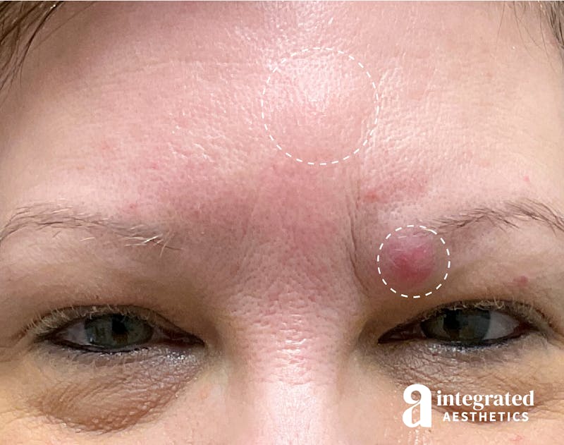 Cysts/Lipomas Before & After Gallery - Patient 157150409 - Image 1