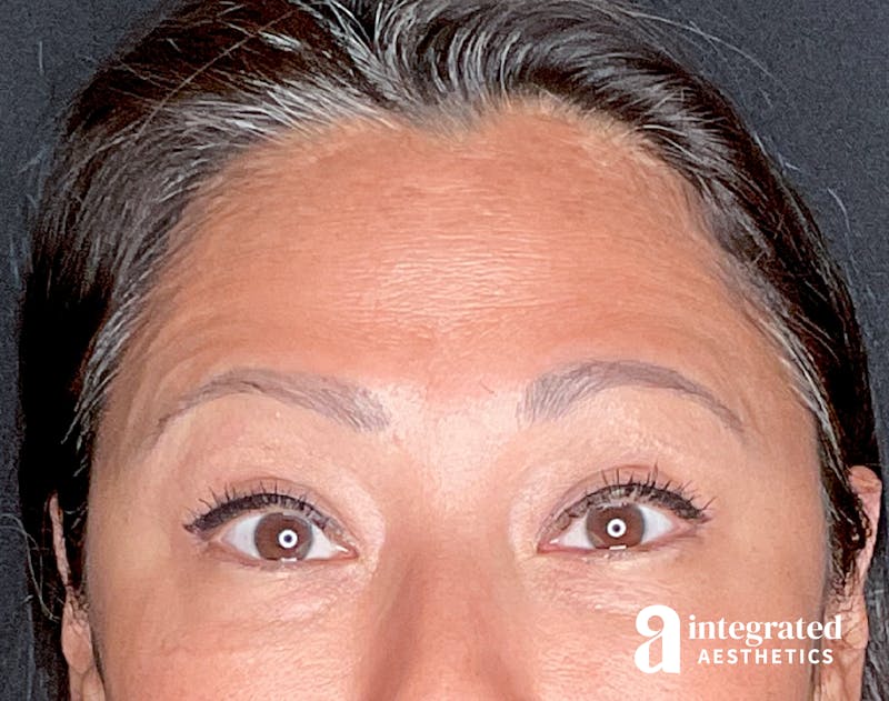 Wrinkle Relaxers Before & After Gallery - Patient 157150571 - Image 6
