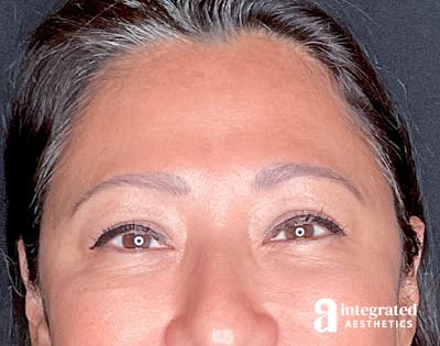 Wrinkle Relaxers Before & After Gallery - Patient 157150571 - Image 2