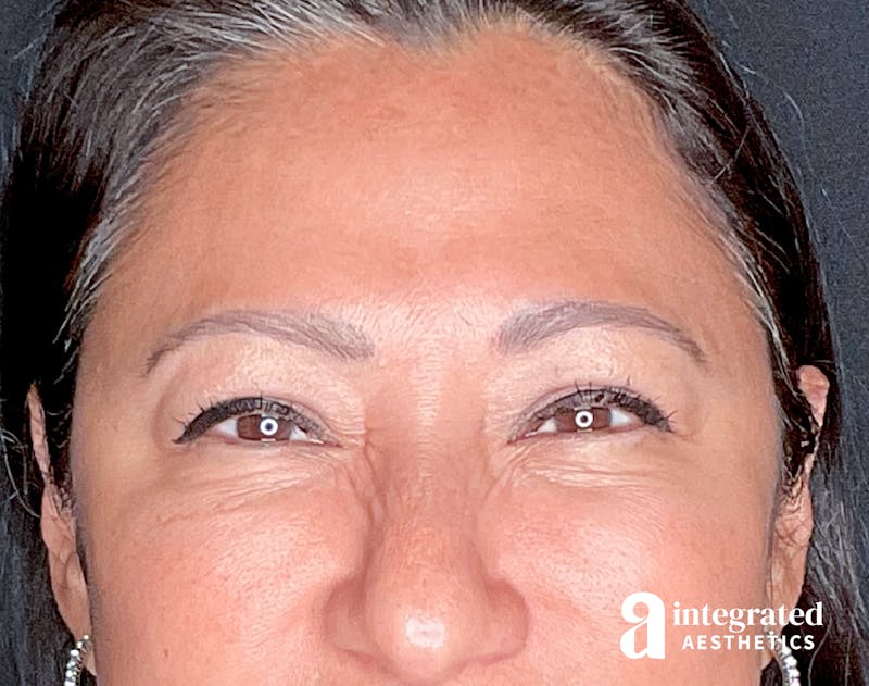 Wrinkle Relaxers Before & After Gallery - Patient 157150571 - Image 8