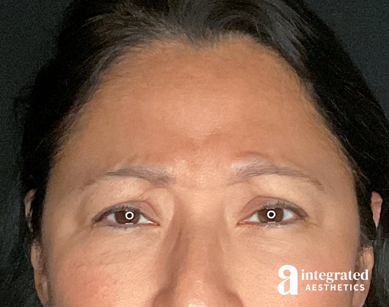 Wrinkle Relaxers Before & After Gallery - Patient 157150571 - Image 3