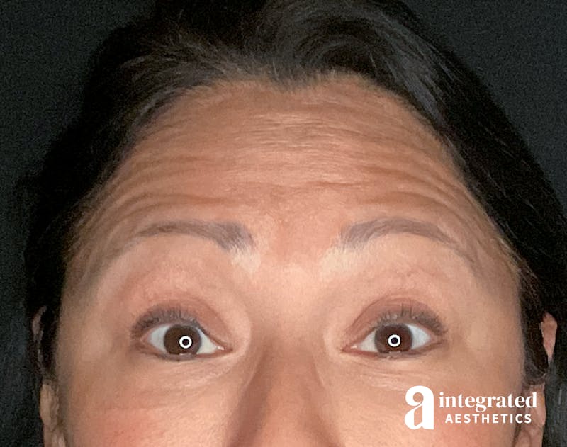 Wrinkle Relaxers Before & After Gallery - Patient 157150571 - Image 5