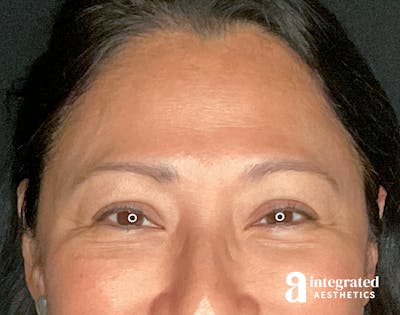 Wrinkle Relaxers Before & After Gallery - Patient 157150571 - Image 1