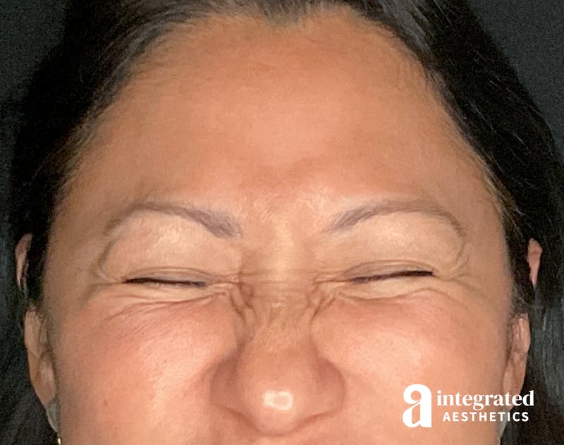 Wrinkle Relaxers Before & After Gallery - Patient 157150571 - Image 7