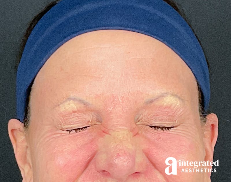 Lip Filler Before & After Gallery - Patient 157150687 - Image 4