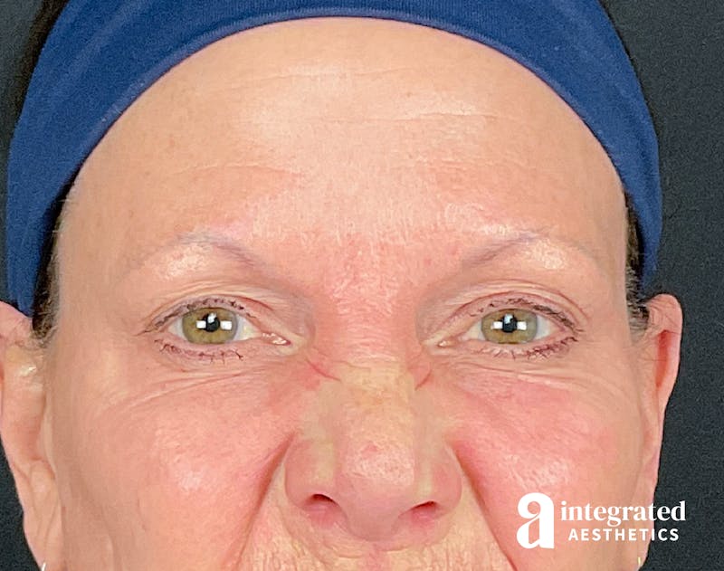Lip Filler Before & After Gallery - Patient 157150687 - Image 6