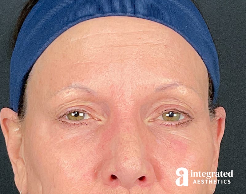 Wrinkle Relaxers Before & After Gallery - Patient 157150676 - Image 2