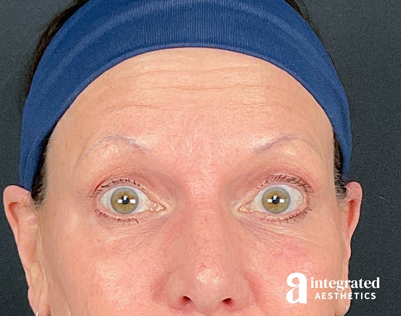 Lip Filler Before & After Gallery - Patient 157150687 - Image 8