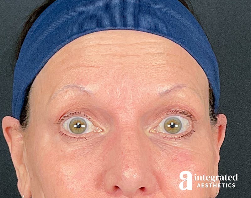 Dermal Fillers Before & After Gallery - Patient 157150693 - Image 8