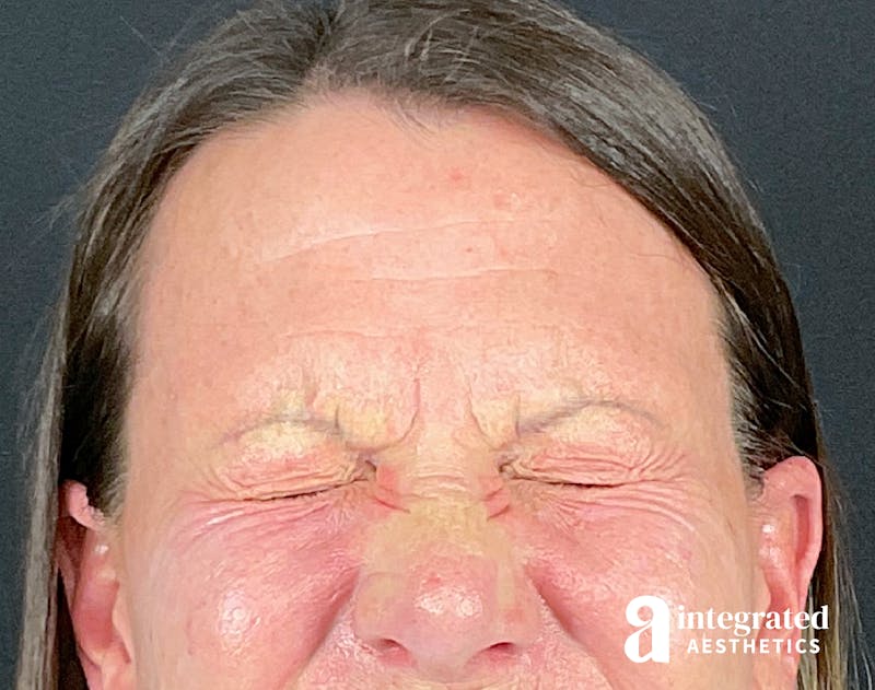 Wrinkle Relaxers Before & After Gallery - Patient 157150676 - Image 3