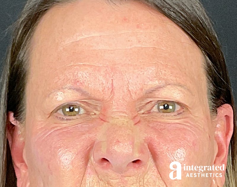 Lip Filler Before & After Gallery - Patient 157150687 - Image 5