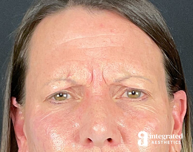 Wrinkle Relaxers Before & After Gallery - Patient 157150676 - Image 1