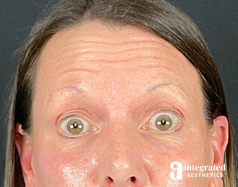 Lip Filler Before & After Gallery - Patient 157150687 - Image 7
