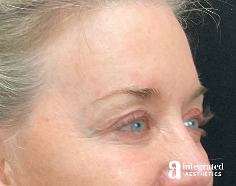 Blepharoplasty Before & After Gallery - Patient 157150793 - Image 3