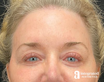 Blepharoplasty Before & After Gallery - Patient 157150793 - Image 1