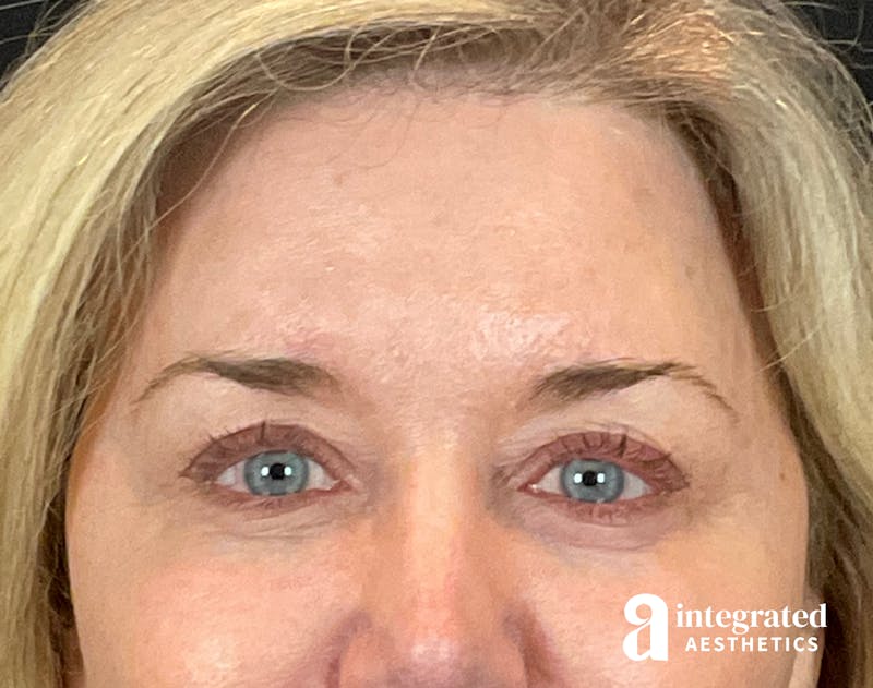 Blepharoplasty Before & After Gallery - Patient 157150793 - Image 2