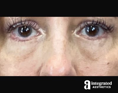 Blepharoplasty Before & After Gallery - Patient 185319 - Image 2
