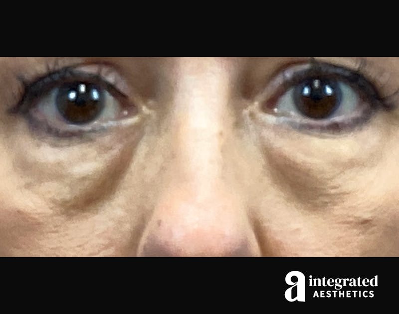 Blepharoplasty Before & After Gallery - Patient 185319 - Image 1