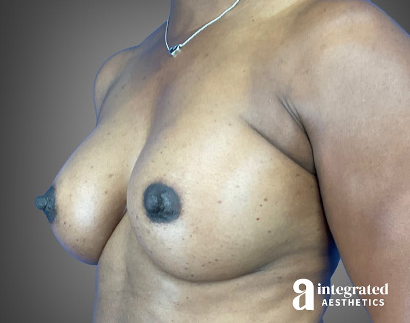 Breast Augmentation Before & After Gallery - Patient 276669 - Image 8