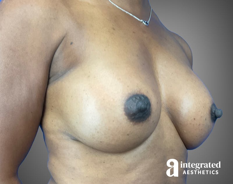 Breast Augmentation Before & After Gallery - Patient 276669 - Image 4