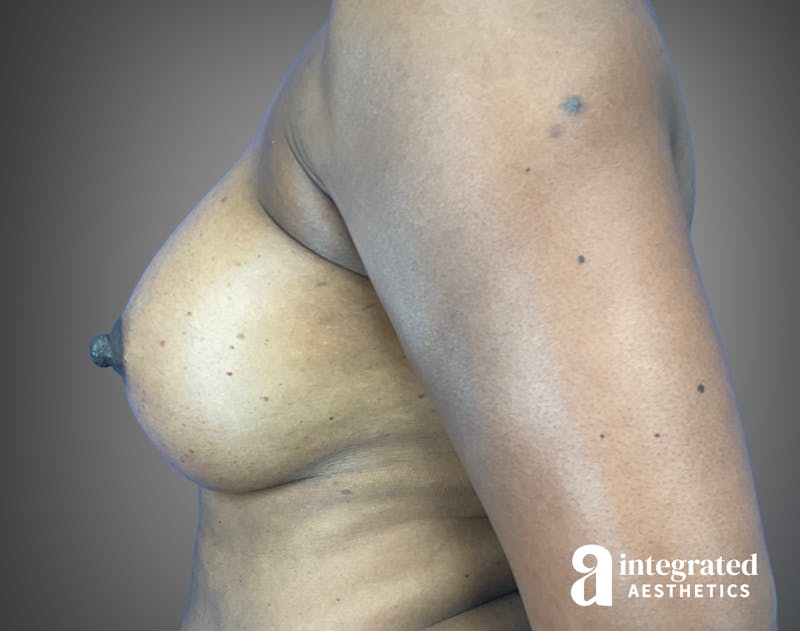 Breast Augmentation Before & After Gallery - Patient 276669 - Image 10