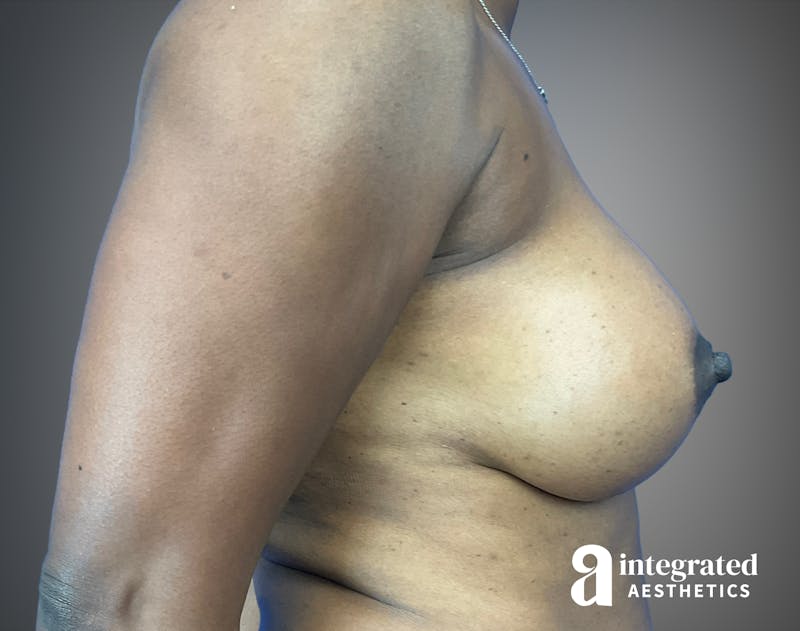 Breast Augmentation Before & After Gallery - Patient 276669 - Image 6