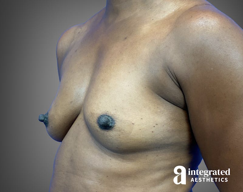 Breast Augmentation Before & After Gallery - Patient 276669 - Image 7