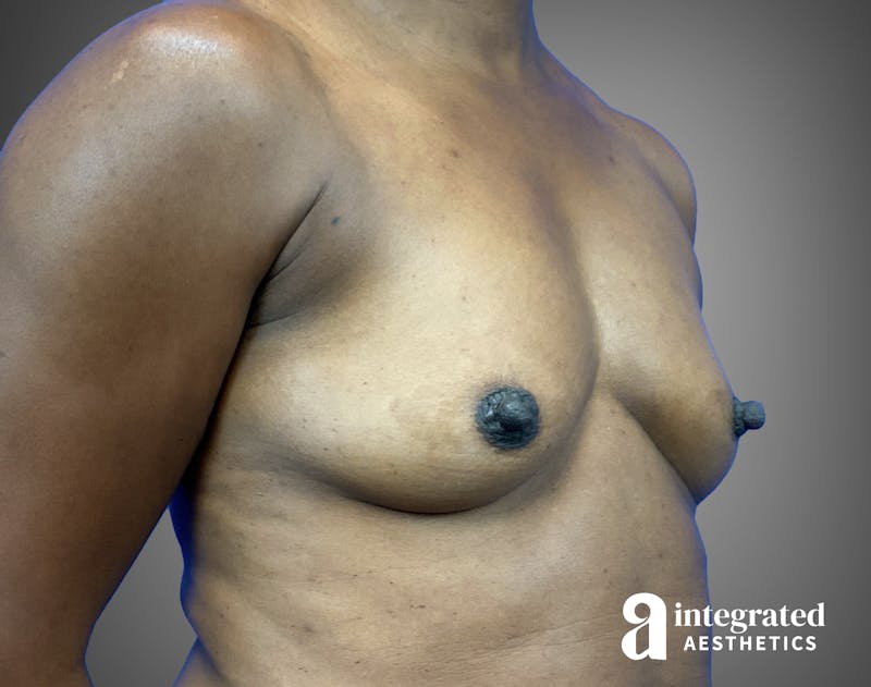 Breast Augmentation Before & After Gallery - Patient 276669 - Image 3