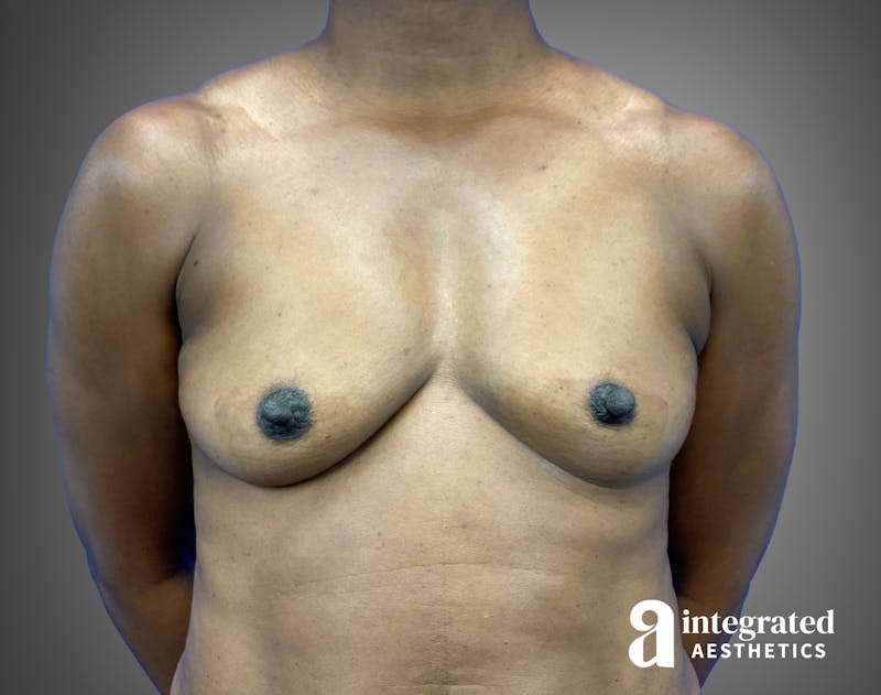 Breast Augmentation Before & After Gallery - Patient 276669 - Image 1