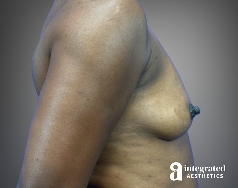 Breast Augmentation Before & After Gallery - Patient 276669 - Image 5