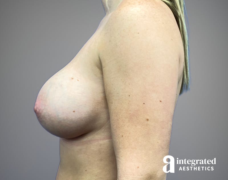 Breast Augmentation Before & After Gallery - Patient 232509 - Image 10